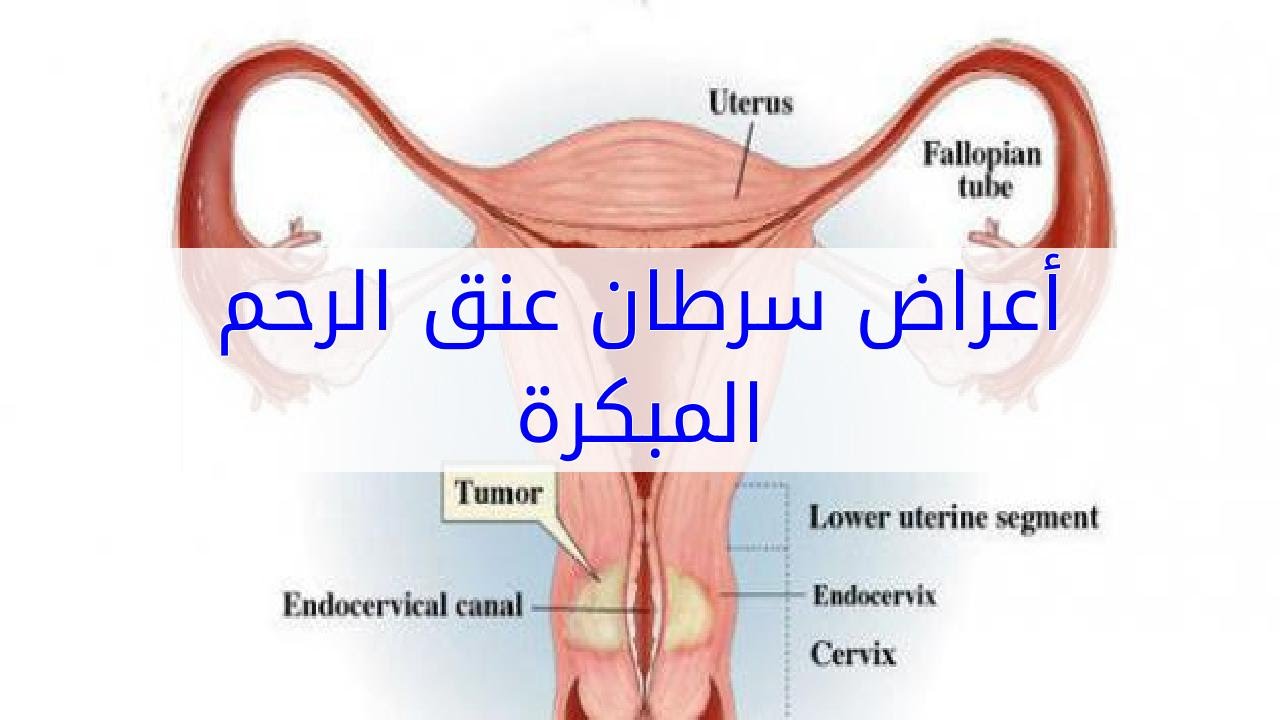 اعراض سرطان الرحم - الاكتشاف المبكر لسرطان الرحم 1288 3