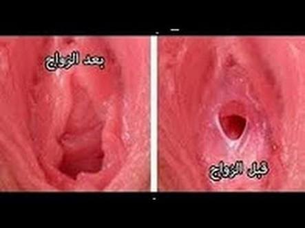 ترقيع البكاره في المنزل- استرداد العذرية دون خطر او مشاكل 5714 9