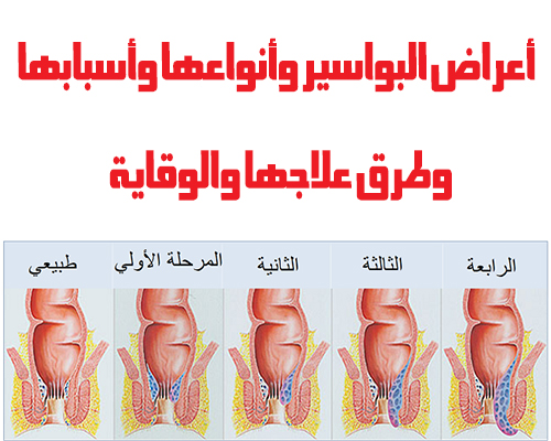 ماهي اعراض البواسير , اكثر الامراض الما