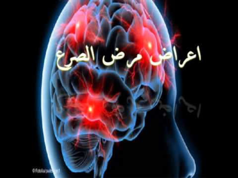 مرض الصرع - علاج مرض الصرع 4984