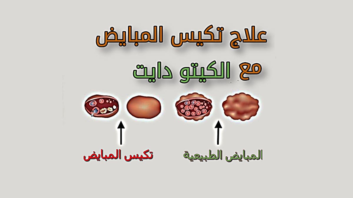 الحل النهائى لمشكله التكيس - علاج التكيس 4106 2