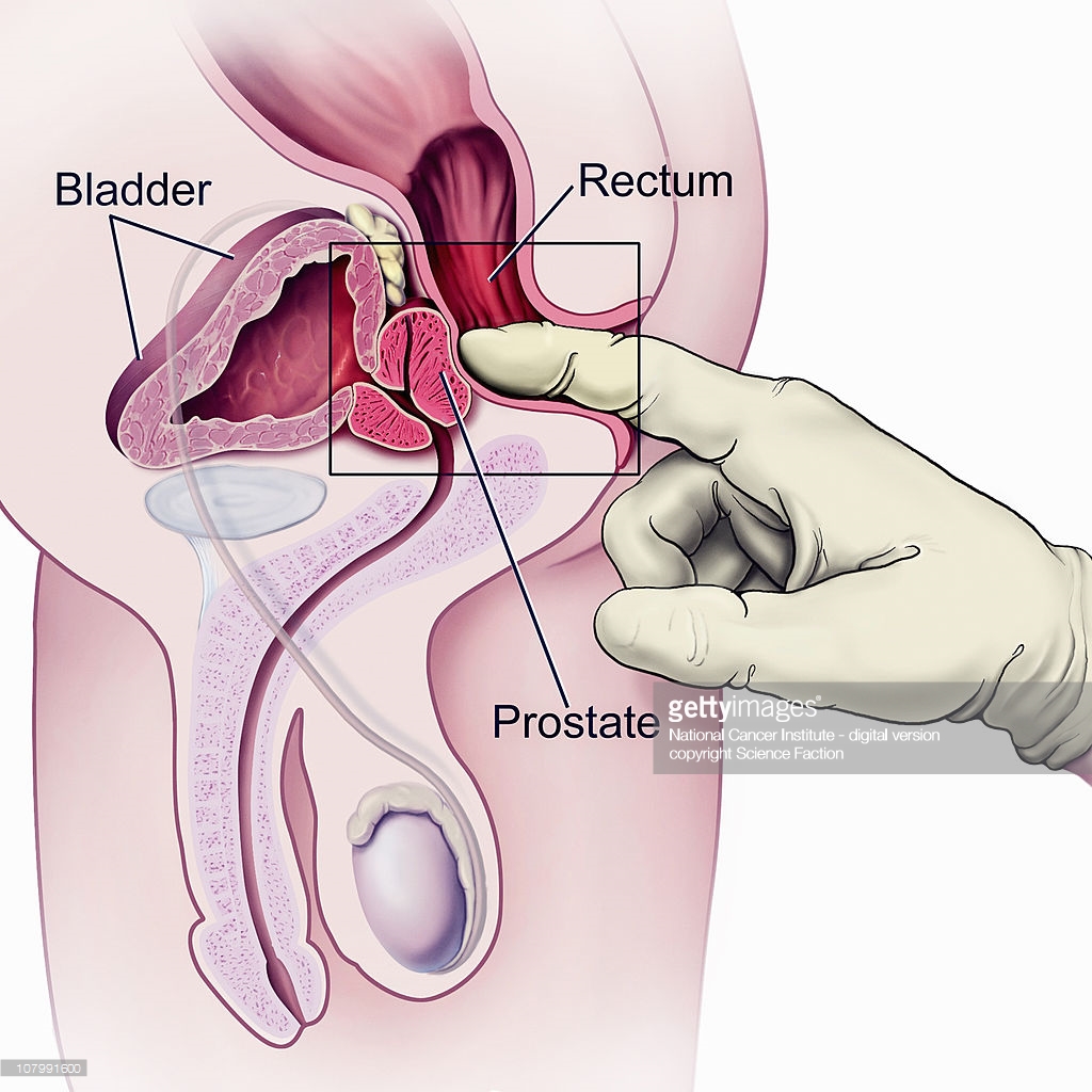 علاج البروستاتا , طرق علاج البروستاتا