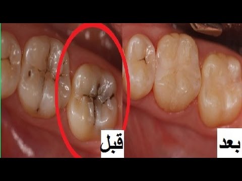 بالصور تسوس الاسنان - اكثر الامور سوءا 12739 9