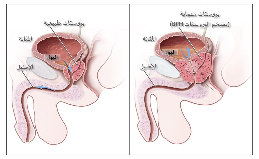 اعراض البروستاتا - معلومات هامة عن مرض البروستاتا 5916 3