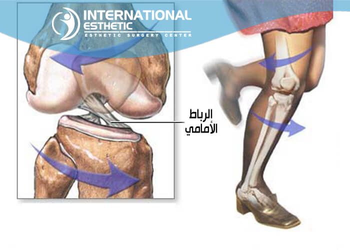 عملية الرباط الصليبي - تطور العمليات الجراحيه 3811 1