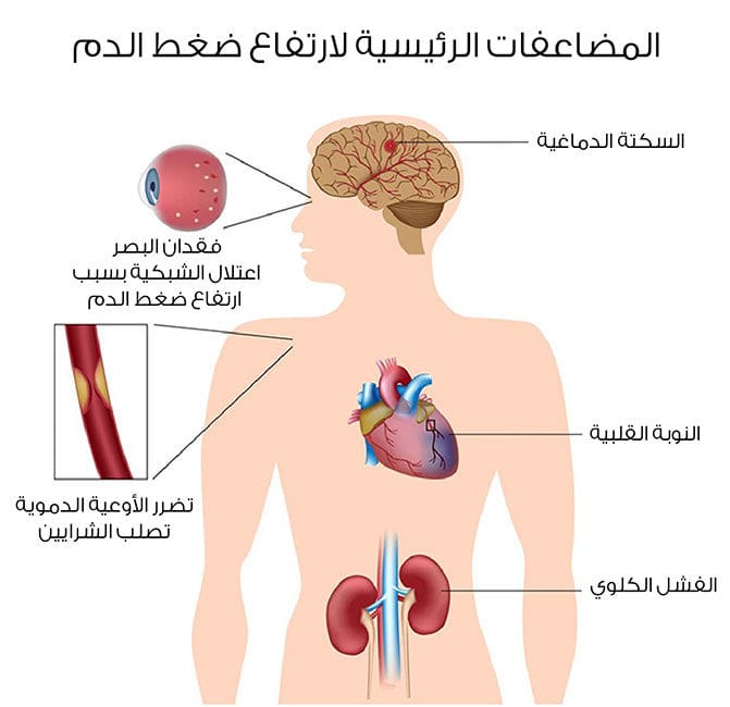 اعراض الضغط - مرض الضغط اعراضه وعلاجه 6115 1