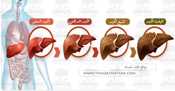 علاج تليف الكبد - علاج تشمع الكبد 2876 2