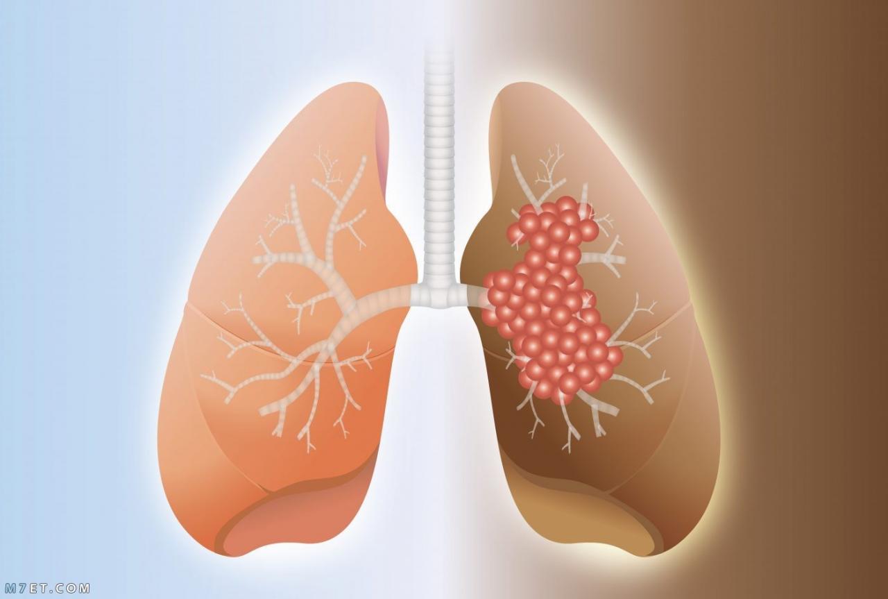 علاج تليف الرئة بالعسل والثوم، سهل وفعال 17218