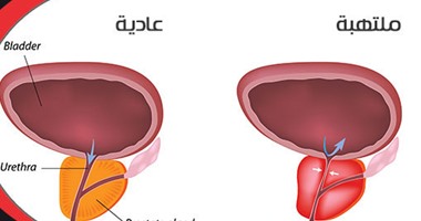 حجم البروستاتا 32