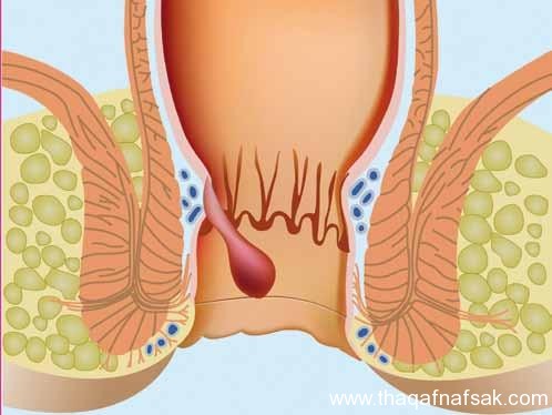 مرض البواسير - طريقة لعلاج البواسير 2570 2