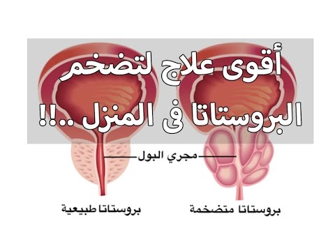 اسباب تضخم البروستاتا - اعراض مرض البروستاتا واسبابه 2805