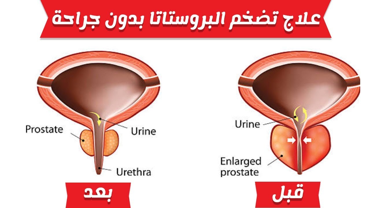 علاج تضخم البروستاتا , طرق علاج تضخم البروستاتا بطريقه مضمونه