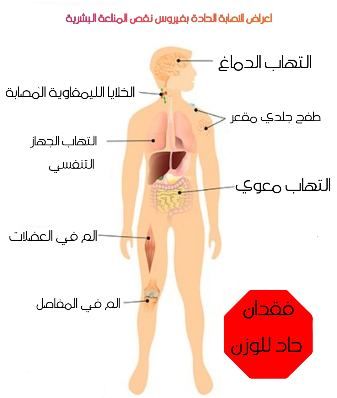 كيف تعرف اذا كنت مصاب بهذا المرض ام لا - اعراض الايدز 4120 1