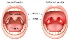 علاج التهاب اللوزتين , كيفية علاج اللوز