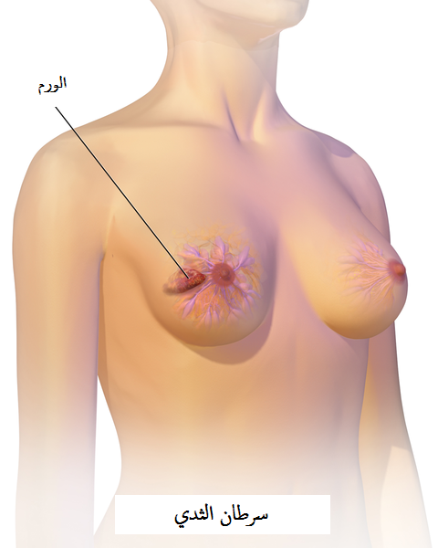 التهاب الثدي - الامراض التى تصيب الانثى 4861 1