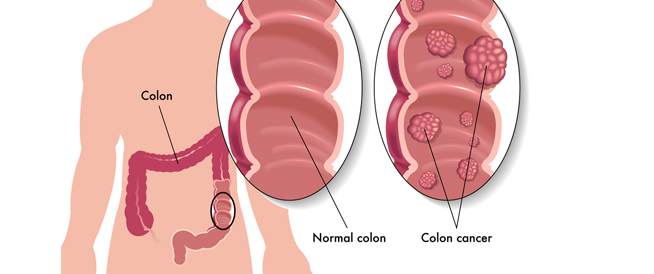 تعرف على سرطان القولون - ما هو سرطان القولون 12612 1