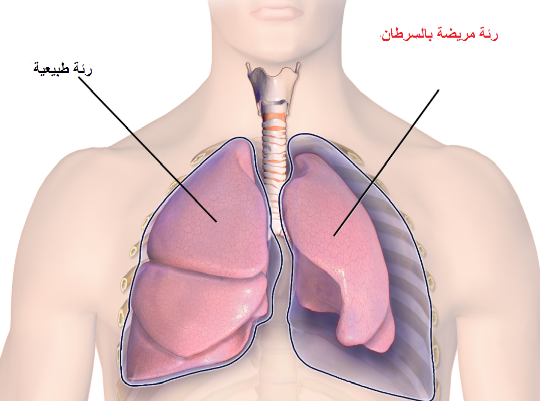 اعراض سرطان الرئة - ما هو سرطان الرئة وما هى اعراضة- 5878