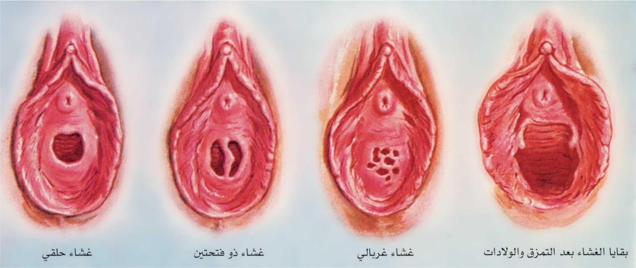 ترقيع البكاره في المنزل- استرداد العذرية دون خطر او مشاكل 5714 1