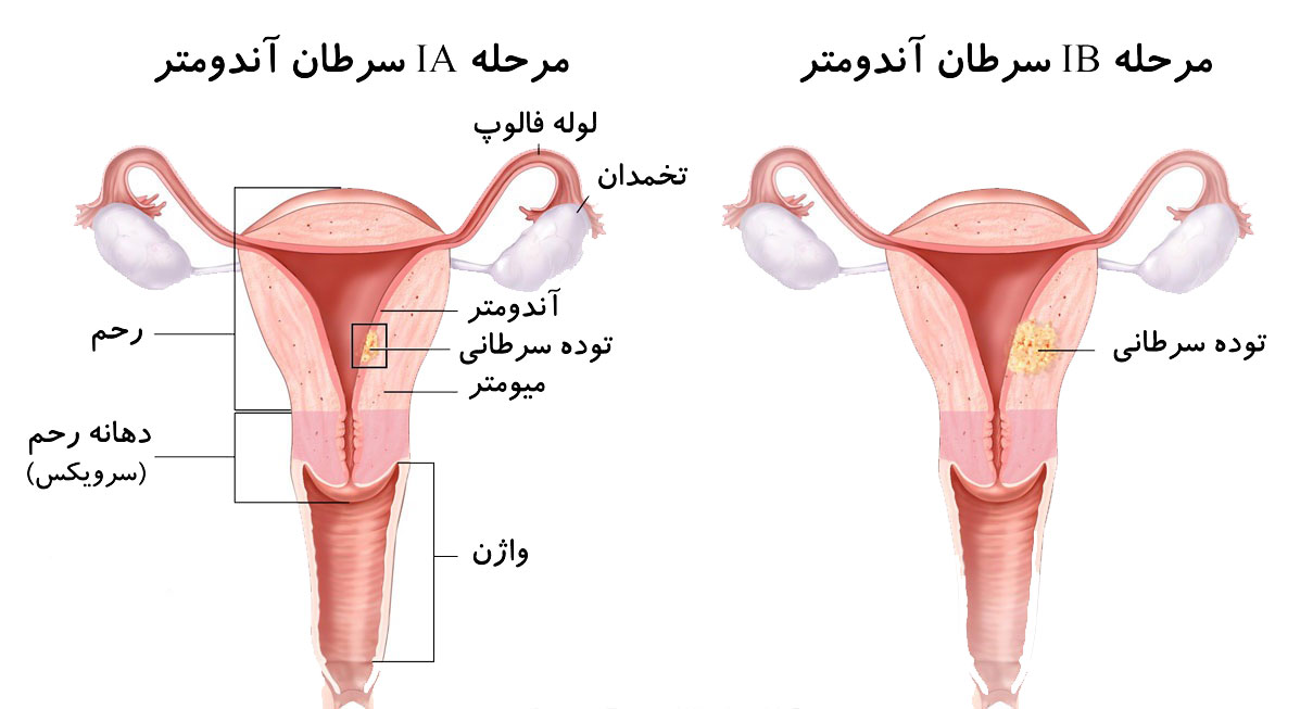 اعراض سرطان الرحم - الاكتشاف المبكر لسرطان الرحم 1288 1