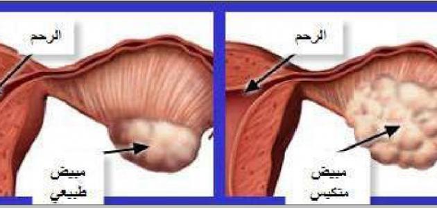 ماهي اعراض تكيس المبايض - علاج تكيس المبايض 4352 1