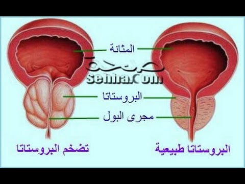 علاج البروستاتا بالاعشاب , امراض البروستاتا وعلاجها بالاعشاب