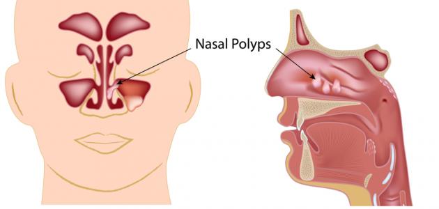 طرق علاج لحمية الانف ، لتخلص منها نهائيا 17094 1