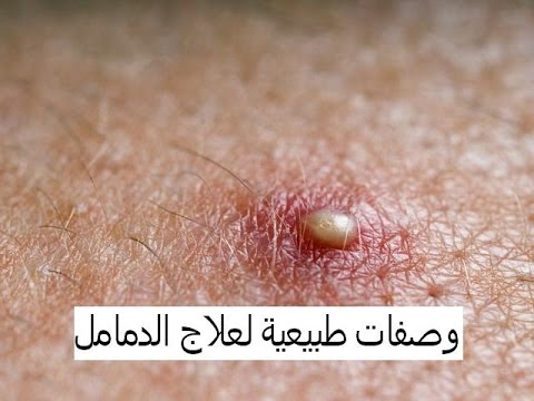 علاج الدمل , كيفية التخلص من الدمل و اثاره