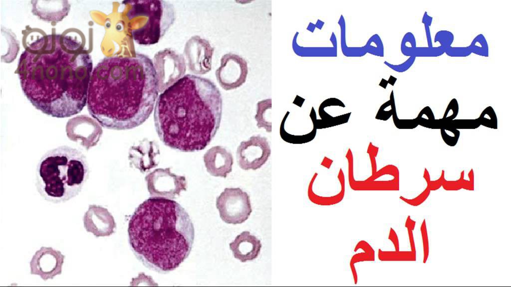 اعراض سرطان الدم