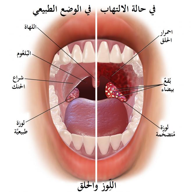 عادات خاطئة - علاج التهاب الحلق 895